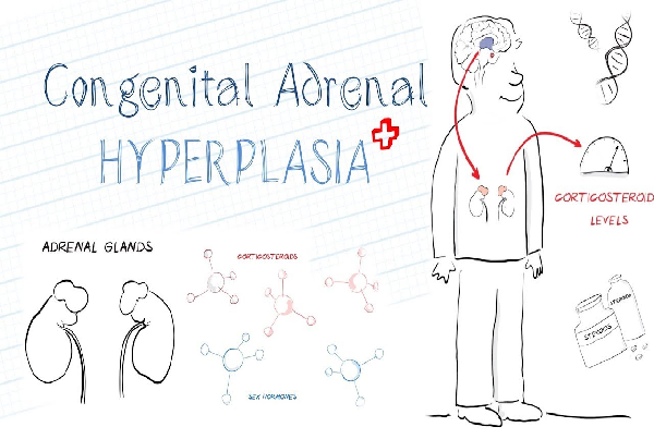 Congenital Adrenal Hyperplasia